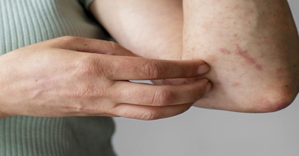 Sin defunciones por dengue en &uacute;ltimas 24 horas en Puebla: Salud