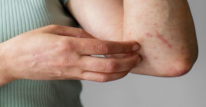 Reporta Salud 44 nuevas hospitalizaciones por dengue