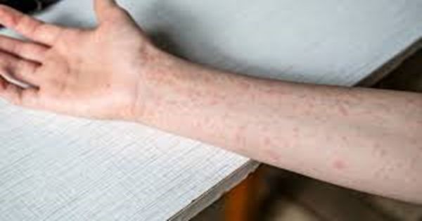 Reportan m&aacute;s de dos mil casos de sarampi&oacute;n en M&eacute;xico