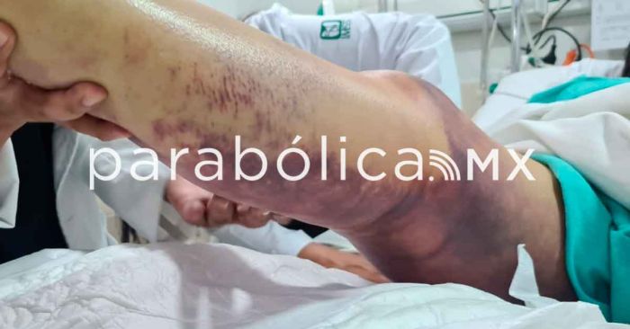 Sobrevive a mordedura de víbora por atención especializada en el IMSS en CDMX