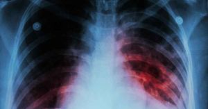 Aumentan casos de tuberculosis en México