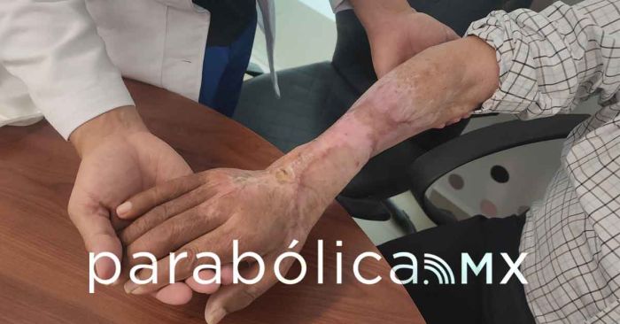 Salva IMSS Aguascalientes brazo de paciente con picadura de araña violinista