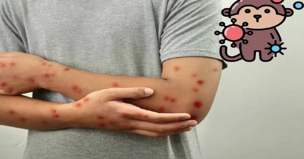 Advierte OMS de contagio masivo por viruela del mono