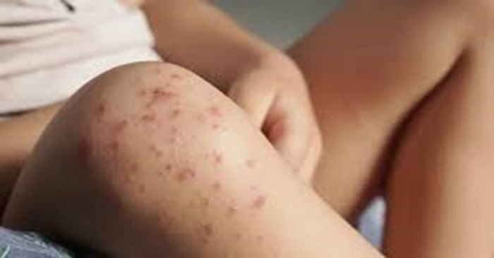 Alertan por brote de virus Coxsackie en Club Alpha 3 de Puebla