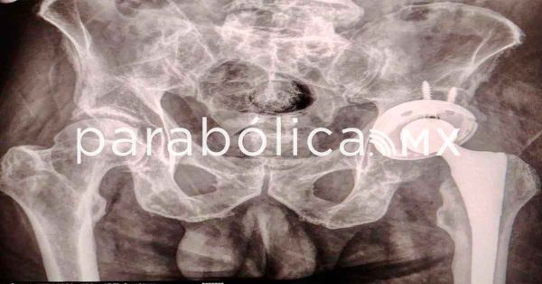 Realiza con &eacute;xito ISSSTEP la primera pr&oacute;tesis de cadera sin costo