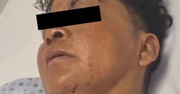 Presenta &quot;La China&quot; traumatismo craneoencefálico leve: Salud Puebla