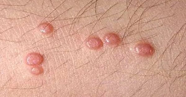 Esto sabemos del molusco contagioso; es un nuevo virus