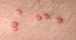 Esto sabemos del molusco contagioso; es un nuevo virus