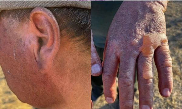 Padecen brigadistas de Tlachichuca los efectos del combate a incendios forestales