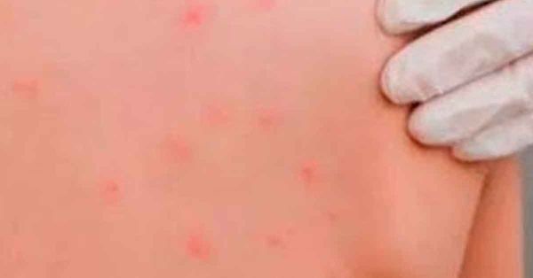 Confirma Salud segundo caso de sarampi&oacute;n en Puebla