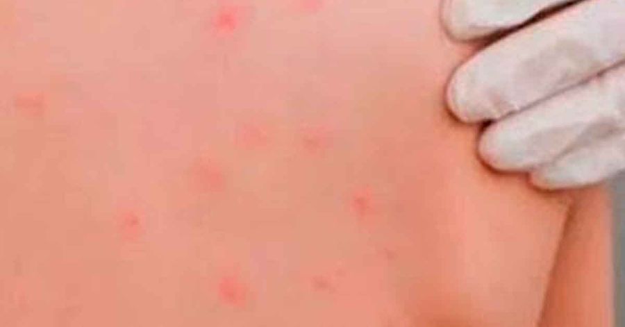 Reporta Puebla m&aacute;s de 200 casos confirmados de sarampi&oacute;n