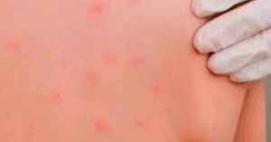 Aplica SEP Puebla protocolo para prevenir el sarampi&oacute;n en escuelas