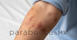 Confirma Secretar&iacute;a de Salud primer caso de sarampi&oacute;n en Puebla